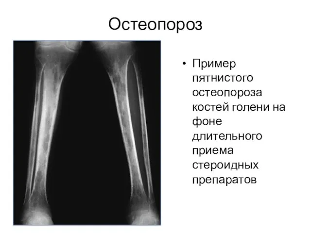 Остеопороз Пример пятнистого остеопороза костей голени на фоне длительного приема стероидных препаратов