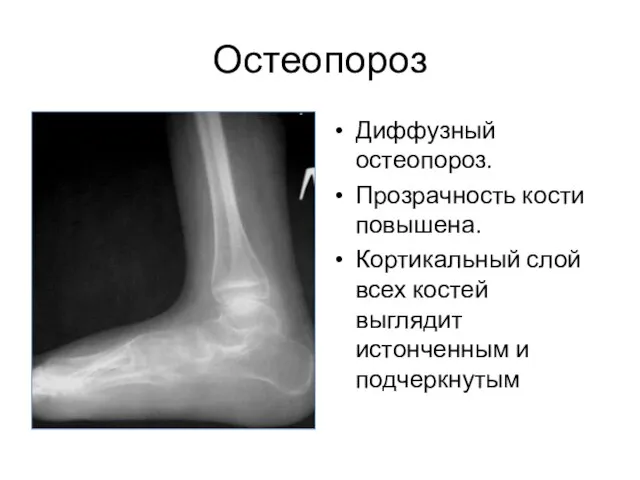 Остеопороз Диффузный остеопороз. Прозрачность кости повышена. Кортикальный слой всех костей выглядит истонченным и подчеркнутым