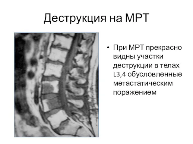 Деструкция на МРТ При МРТ прекрасно видны участки деструкции в телах L3,4 обусловленные метастатическим поражением