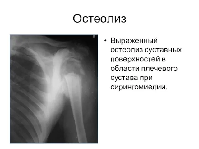 Остеолиз Выраженный остеолиз суставных поверхностей в области плечевого сустава при сирингомиелии.