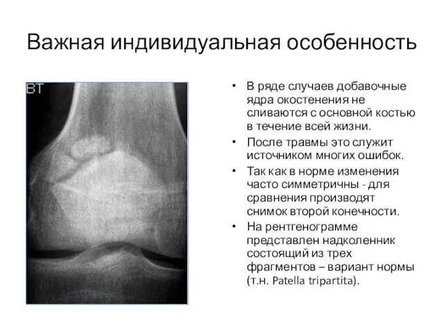 Важная индивидуальная особенность В ряде случаев добавочные ядра окостенения не сливаются