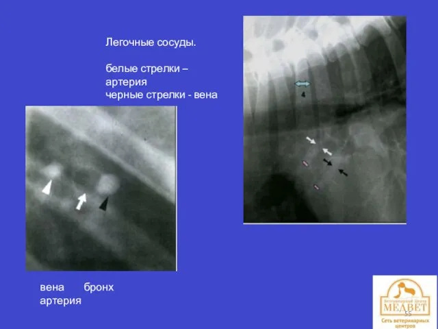 Легочные сосуды. белые стрелки – артерия черные стрелки - вена вена бронх артерия