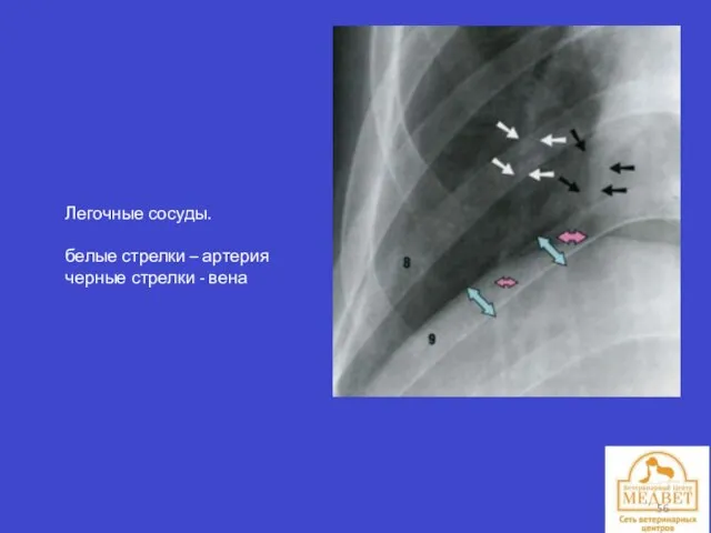 Легочные сосуды. белые стрелки – артерия черные стрелки - вена