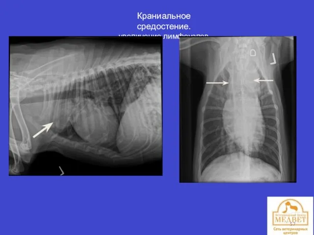 Краниальное средостение. увеличение лимфоузлов