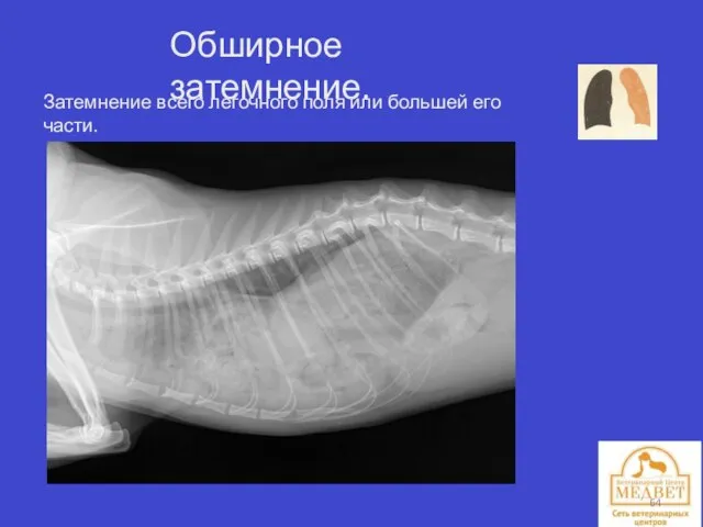 Обширное затемнение. Затемнение всего легочного поля или большей его части.