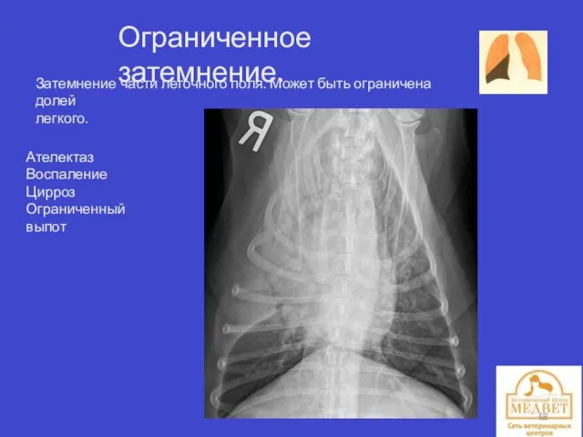 Ограниченное затемнение. Затемнение части легочного поля. Может быть ограничена долей легкого. Ателектаз Воспаление Цирроз Ограниченный выпот