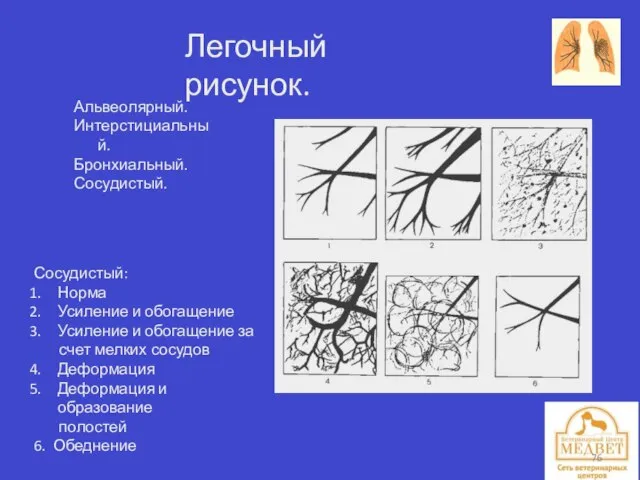 Легочный рисунок. Альвеолярный. Интерстициальный. Бронхиальный. Сосудистый. Сосудистый: Норма Усиление и обогащение