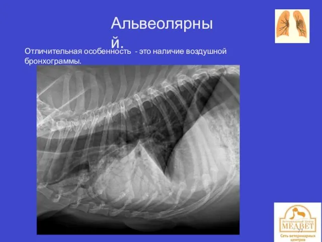 Альвеолярный. Отличительная особенность - это наличие воздушной бронхограммы.