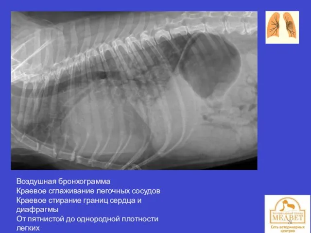 Воздушная бронхограмма Краевое сглаживание легочных сосудов Краевое стирание границ сердца и