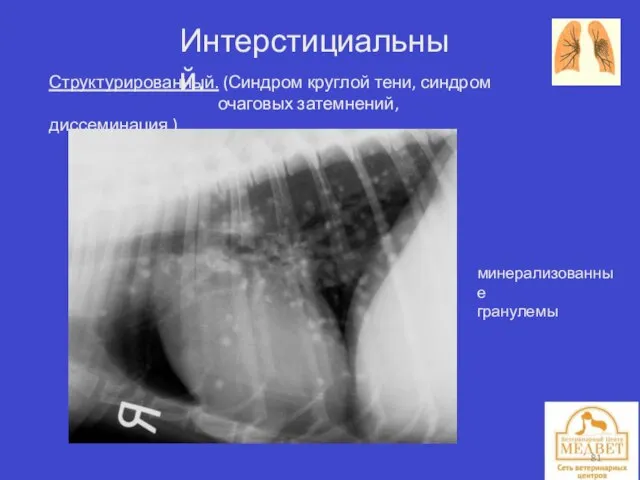 Интерстициальный. Структурированный. (Синдром круглой тени, синдром очаговых затемнений, диссеминация.) минерализованные гранулемы