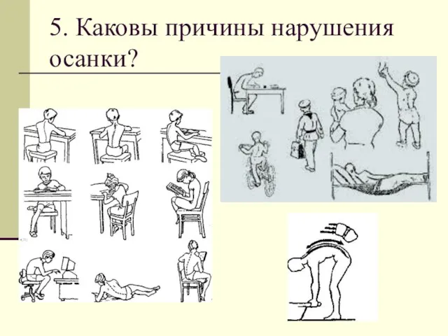 5. Каковы причины нарушения осанки?