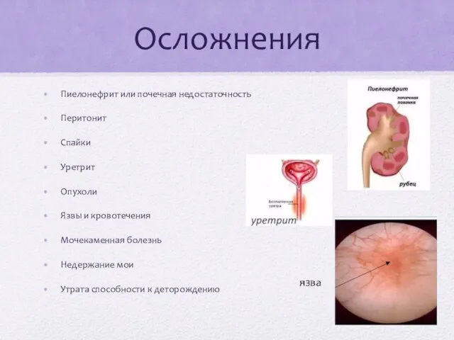 Осложнения Пиелонефрит или почечная недостаточность Перитонит Спайки Уретрит Опухоли Язвы и