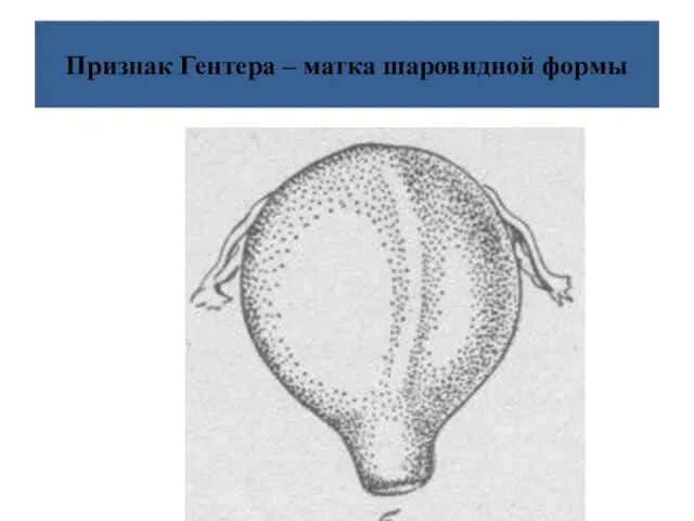 Признак Гентера – матка шаровидной формы