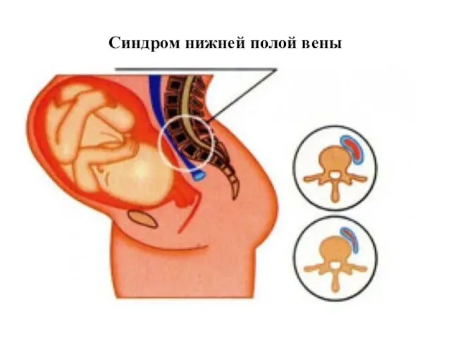 Синдром нижней полой вены