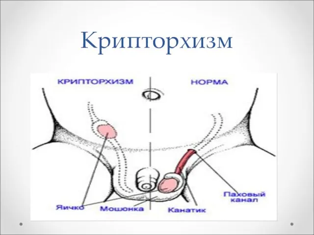 Крипторхизм