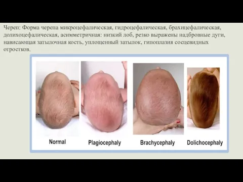 Череп: Форма черепа микроцефалическая, гидроцефалическая, брахицефалическая, долихоцефалическая, асимметричная: низкий лоб, резко