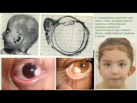 а- липодермоид наружного края левого глаза, преаурикулярные придатки, эпибульбарный дермоид (стрелка)