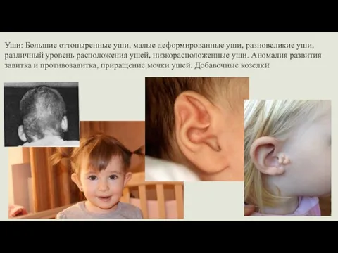 Уши: Большие оттопыренные уши, малые деформированные уши, разновеликие уши, различный уровень