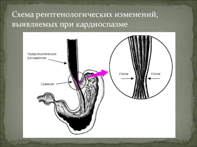 Схема рентгенологических изменений, выявляемых при кардиоспазме