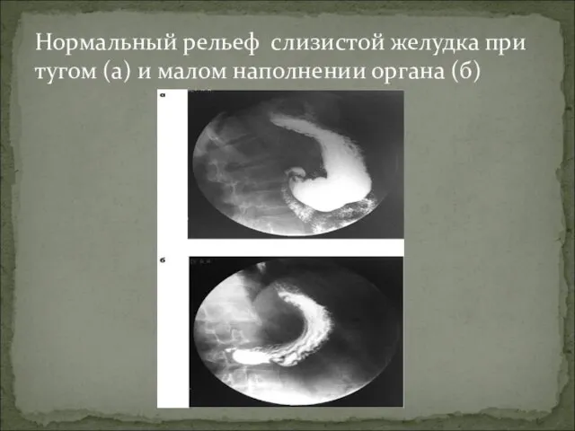 Нормальный рельеф слизистой желудка при тугом (а) и малом наполнении органа (б)