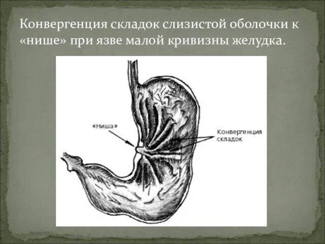 Конвергенция складок слизистой оболочки к «нише» при язве малой кривизны желудка.