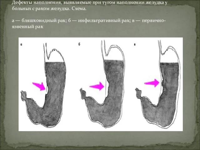 Дефекты наполнения, выявляемые при тугом наполнении желудка у больных с раком