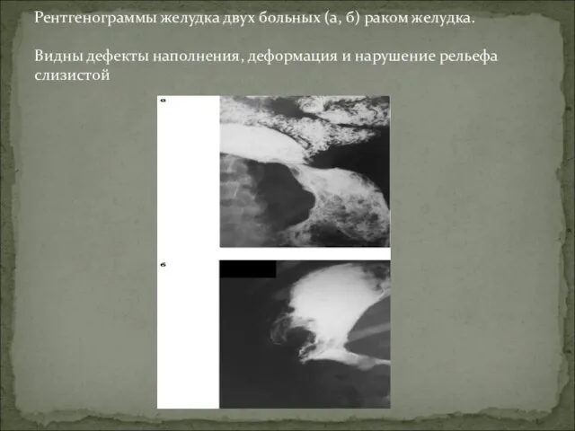 Рентгенограммы желудка двух больных (а, б) раком желудка. Видны дефекты наполнения, деформация и нарушение рельефа слизистой