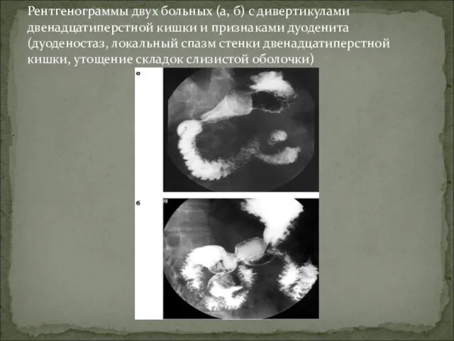 Рентгенограммы двух больных (а, б) с дивертикулами двенадцатиперстной кишки и признаками