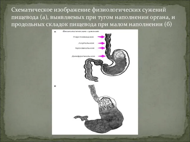 Схематическое изображение физиологических сужений пищевода (а), выявляемых при тугом наполнении органа,