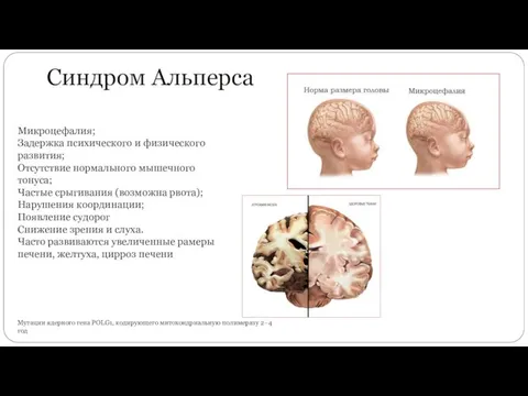 Синдром Альперса Мутации ядерного гена POLG1, кодирующего митохондриальную полимеразу 2–4 год