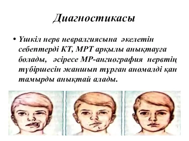 Диагностикасы Үшкіл нерв невралгиясына әкелетін себептерді КТ, МРТ арқылы анықтауға болады,