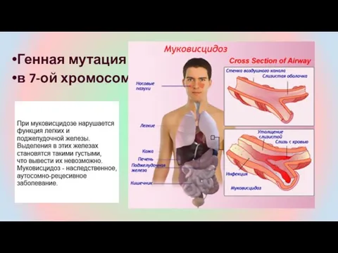 Генная мутация в 7-ой хромосоме