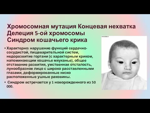 Хромосомная мутация Концевая нехватка Делеция 5-ой хромосомы Синдром кошачьего крика Характерно: