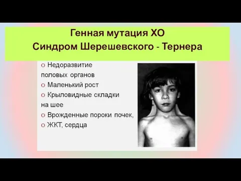 Генная мутация ХО Синдром Шерешевского - Тернера