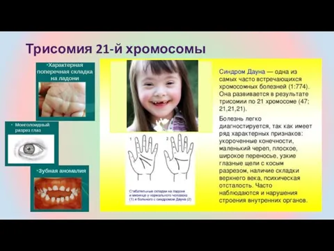 Трисомия 21-й хромосомы