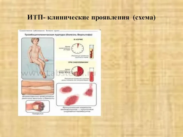 ИТП- клинические проявления (схема)