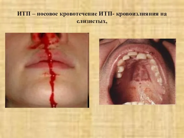 ИТП – носовое кровотечение ИТП- кровоизлияния на слизистых,