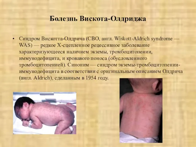 Болезнь Вискота-Олдриджа Синдром Вискотта-Олдрича (СВО, англ. Wiskott-Aldrich syndrome — WAS) —