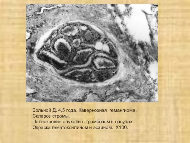 Больной Д. 4,5 года. Кавернозная гемангиома. Склероз стромы. Полнокровие опухоли с