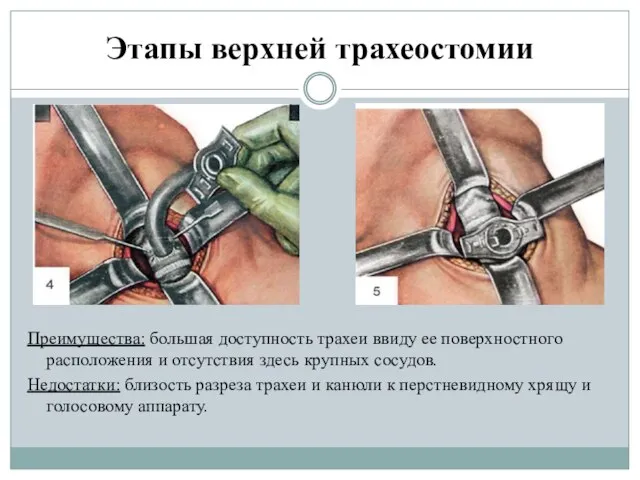 Этапы верхней трахеостомии Преимущества: большая доступность трахеи ввиду ее поверхностного расположения