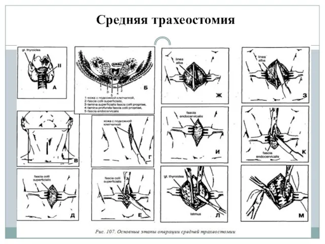 Средняя трахеостомия