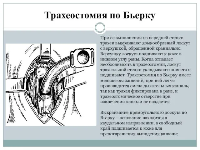 Трахеостомия по Бьерку При ее выполнении из передней стенки трахеи выкраивают