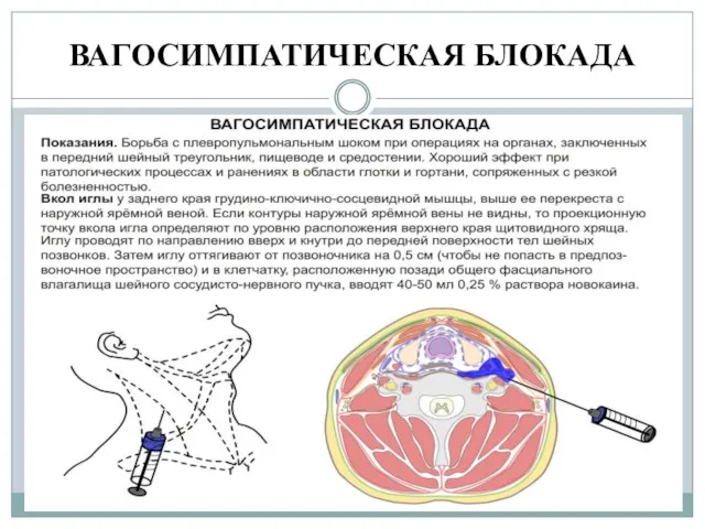 ВАГОСИМПАТИЧЕСКАЯ БЛОКАДА