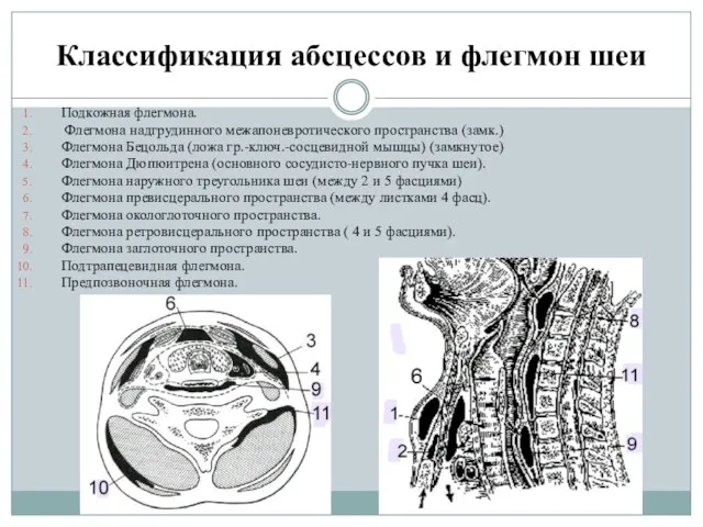 Классификация абсцессов и флегмон шеи Подкожная флегмона. Флегмона надгрудинного межапоневротического пространства