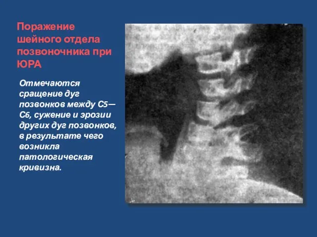 Поражение шейного отдела позвоночника при ЮРА Отмечаются сращение дуг позвонков между