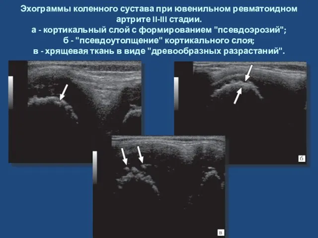 Эхограммы коленного сустава при ювенильном ревматоидном артрите II-III стадии. а -