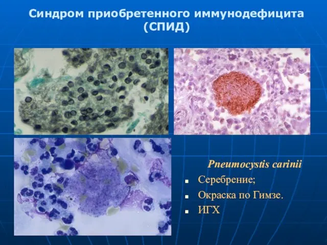 Синдром приобретенного иммунодефицита (СПИД) Pneumocystis carinii Серебрение; Окраска по Гимзе. ИГХ