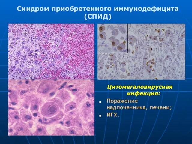 Синдром приобретенного иммунодефицита (СПИД) Цитомегаловирусная инфекция: Поражение надпочечника, печени; ИГХ.