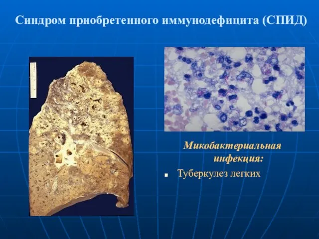 Синдром приобретенного иммунодефицита (СПИД) Микобактериальная инфекция: Туберкулез легких