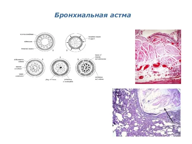 Бронхиальная астма